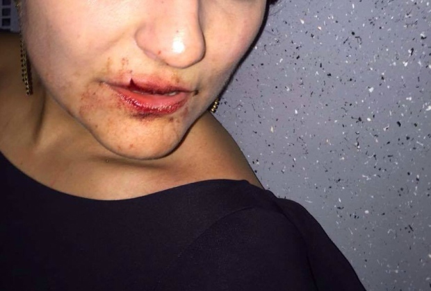 Mulher aparece com a boca sangrando após levar soco na cara de tenente da PM