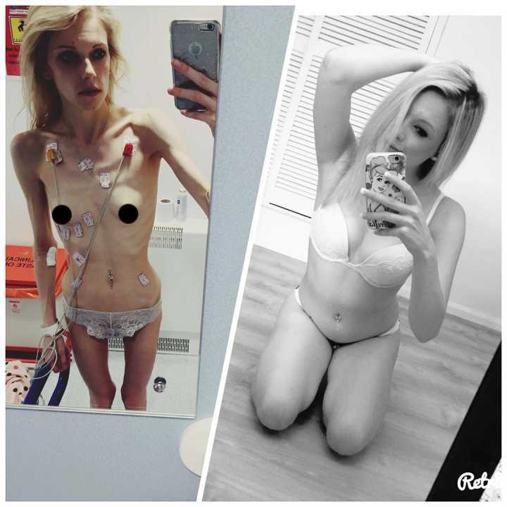 Jodie usou esta imagem para alertar sobre a anorexia no Instagram
