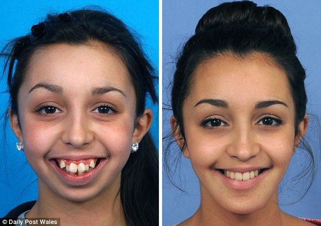 Ellie e Jones antes e depois da cirurgia feita quando tinha 16 anos.