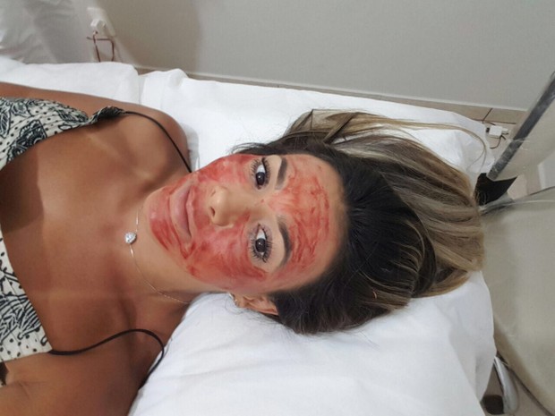 A ex-BBB Fabiana Teixeira faz tratamento de beleza facial com seu próprio sangue