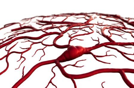 AVC ocorre quando há entupimento ou rompimento dos vasos que levam sangue ao cérebro