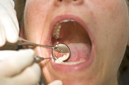 Higiene bucal d eliminar os pontos de cárie rapidamente, fazendo visitas regulares ao dentista são alguns dos cuidados para diminuir problema