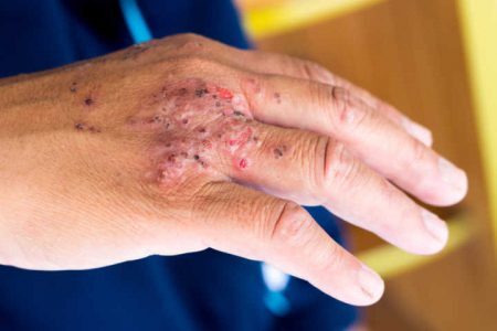 Impetigo é uma infecção bacteriana comum que atinge as camadas superficiais da pele causando feridas e pústulas por todo corpo