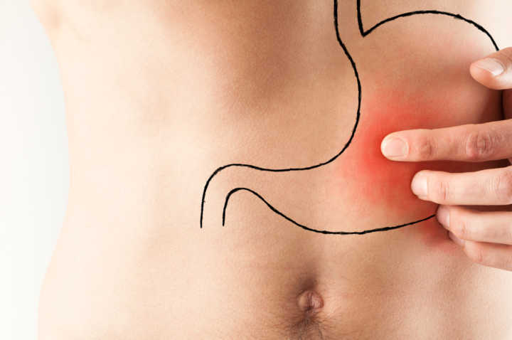 A úlcera gástrica é uma lesão que ocorre no revestimento do estômago