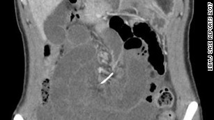 Tomografia computadorizada da paciente revelou objeto que estava perfurando seu intestino delgado