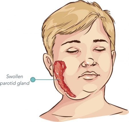 A caxumba é uma infecção viral que afeta as glândulas salivares. Pode ser facilmente prevenida por meio de vacinação