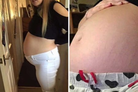 Mulher descobre gravidez e um cisto no ovário por acaso