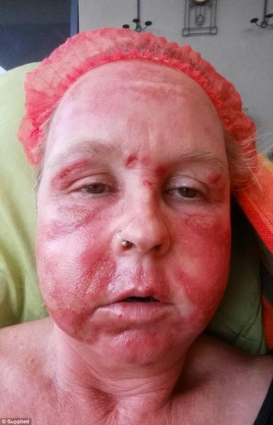 Deborah June também fez um procedimento com laser erbium que deixou seu rosto inchado e com cicatrizes