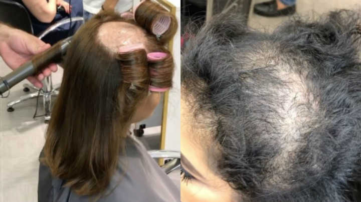 Hair stylist do Líbano faz transformações em mulheres que sofrem com calvície