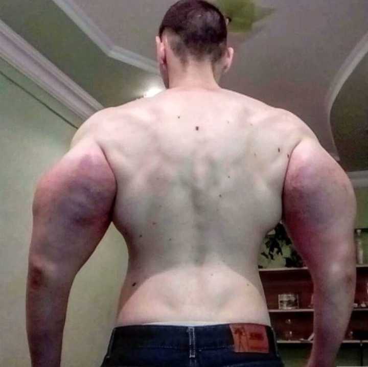 Russo injetou Synthol nos braços para ficar musculoso