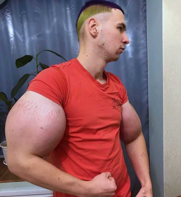 Russo injetou Synthol nos braços para ficar musculoso