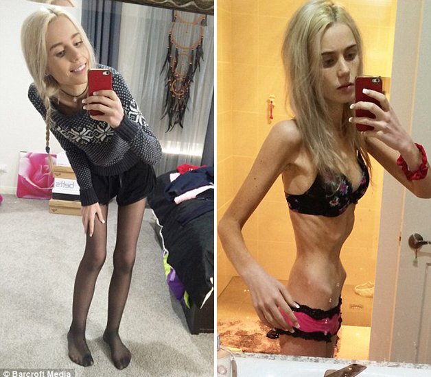 Elle Lietzow sofria com um quadro de anorexia