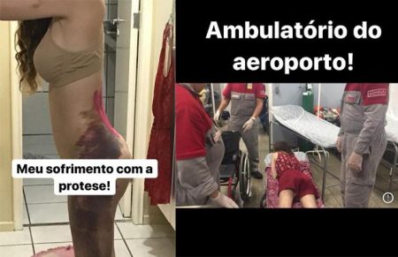 Camilla Uckers postou registros de como ficou seu corpo após colocar silicone no bumbum