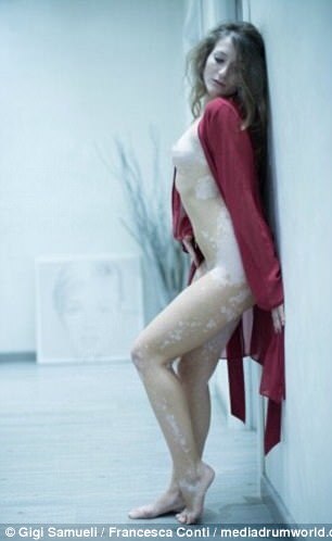 Francesca Conti, modelo com vitiligo