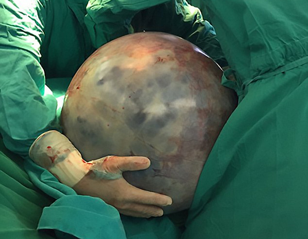 Tumor retirado do ovário da mulher pesava cerca de 31 kg