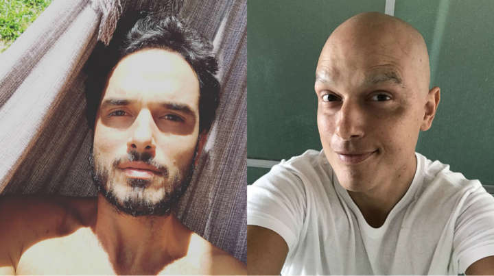 Léo Rosa antes e depois de iniciar o tratamento de combate ao câncer