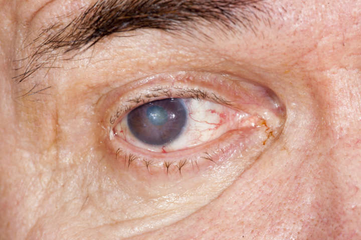 A catarata é muito comum em idosos e leva à perda gradual da visão
