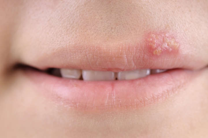 Herpes labial costuma aparecer pela primeira vez na infância