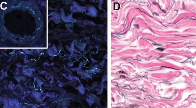 As partes em azul escuro são feixes de colágeno fibrilar. Já a imagem à direita, mostra manchas pretas que são fibras de elastina. Em rosa são as estruturas de colágeno