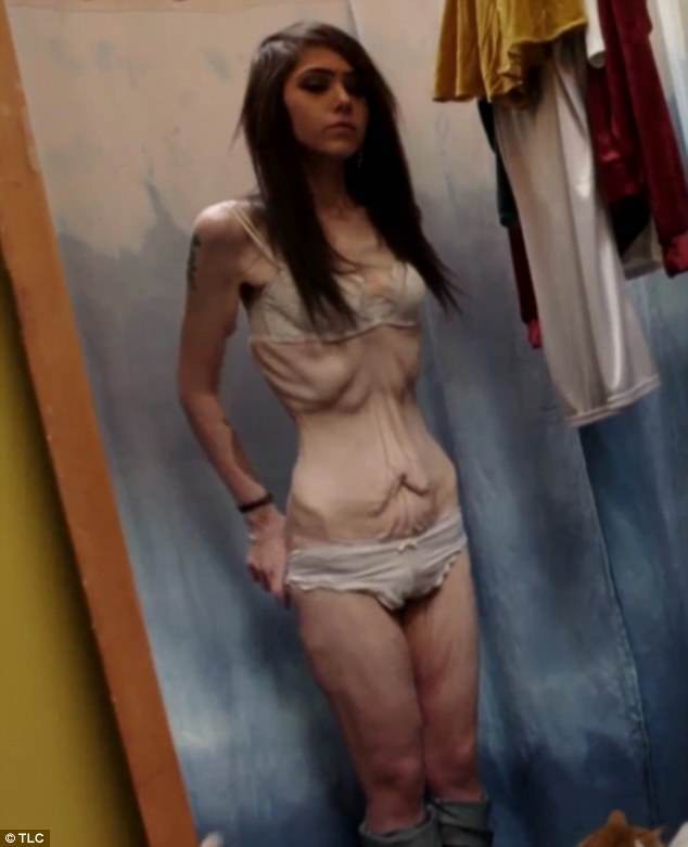 Hope gravou um vídeo em que mostra o seu corpo com o excesso de pele