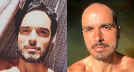 Léo Rosa antes e depois do tratamento contra um câncer