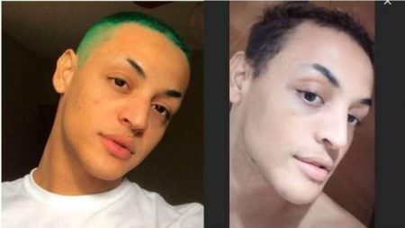 Pabllo Vittar antes e depois de cirurgias no rosto