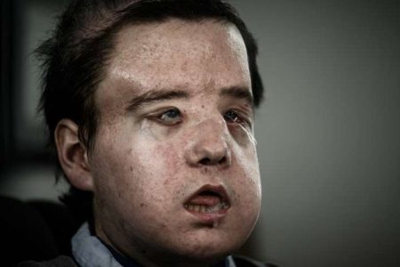 Jérôme Harmon, francês que passou por duas cirurgias de transplante de rosto