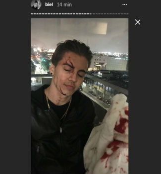 Biel posta foto com rosto machucado após suposta briga com Duda
