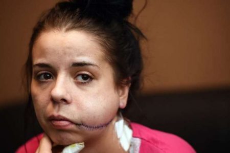 Mulher teve o rosto cortado depois de ataque de ciúmes do ex-namorado
