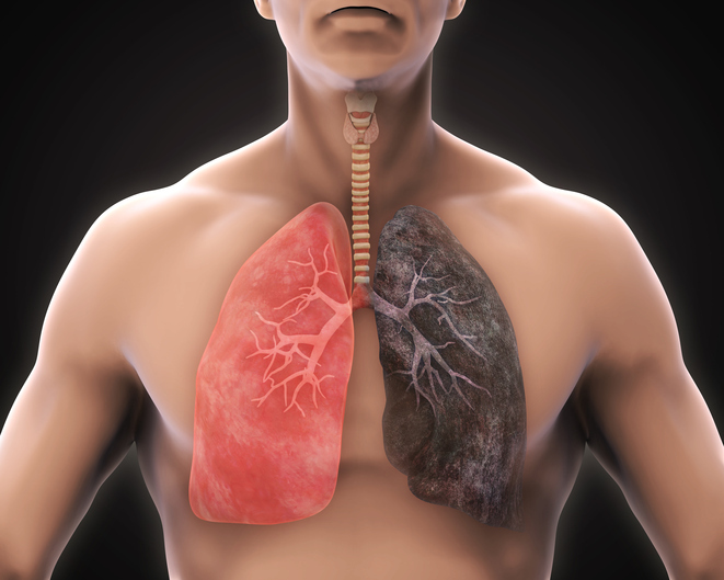 Câncer de pulmão é o mais lembrado