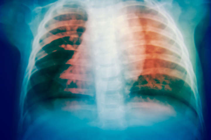 Câncer de pulmão é o de maior incidência no mundo