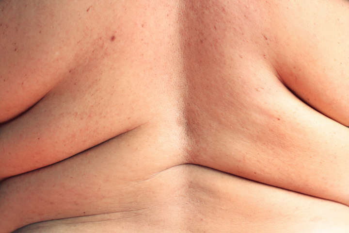 Nossos corpos tendem a estocar gordura nas células para casos de emergência