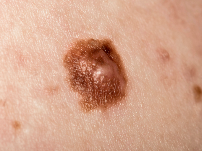 Quando diagnosticado no começo, o melanoma tem mais de 90% de chances de cura