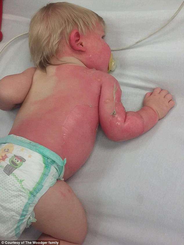 O pequeno Nicholas sofreu queimaduras de segundo grau em mais de 30% do corpo