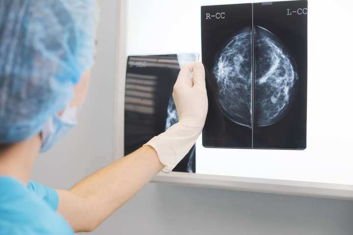 O sensor eletroquímico de DNA detecta mutações no gene BRCA1, que estão associadas aos tumores de mama triplo-negativos