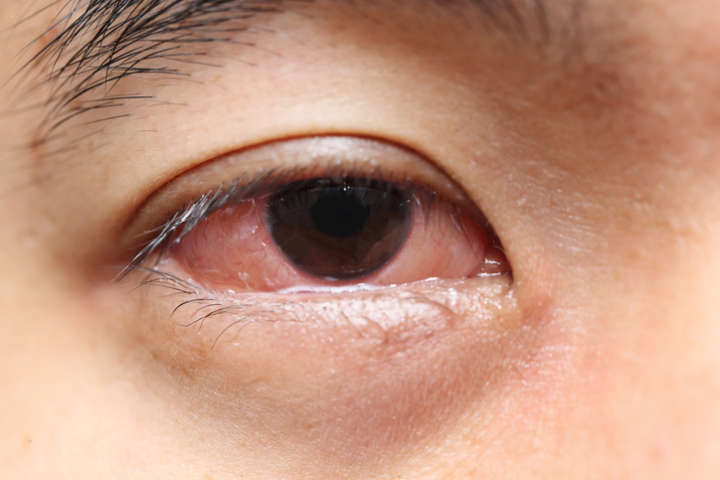Hábito de coçar os olhos é perigoso e pode alterar formato da córnea