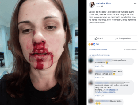 Mulher foi agredida pelo ex e teve o nariz quebrado