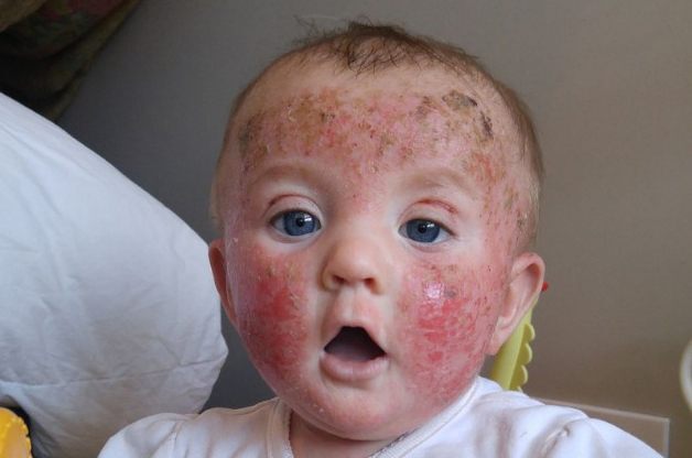 Bebê chorava de dor por conta das feridas em seu rosto