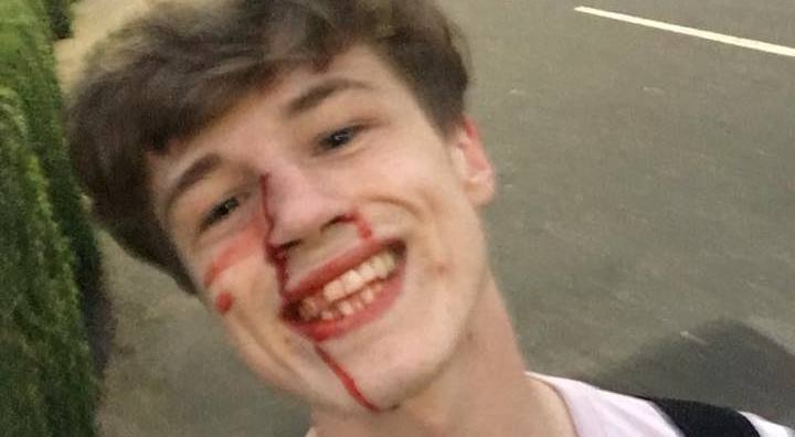 Garoto escocês posta foto ensanguentado e sorrindo após agressão homofóbica