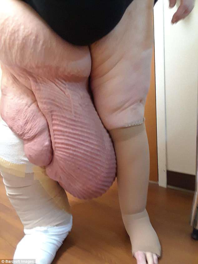A terapia com CDT reduziu o lóbulo principal na perna de Janice de 69 a 46 centímetros