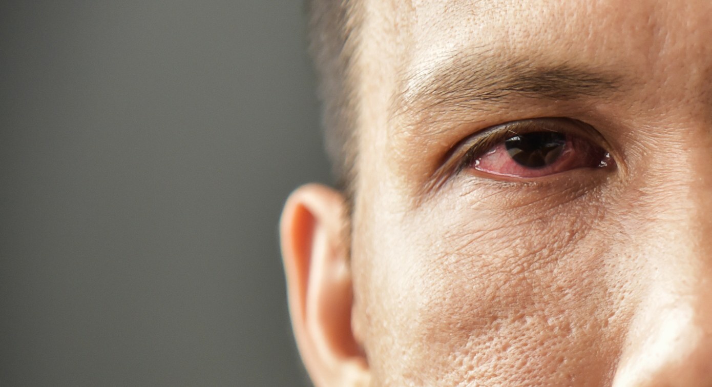 Olho seco é uma anomalia que compromete a produção de lágrimas