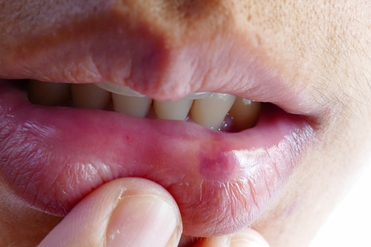 Feridas na boca é um dos sinais de câncer bucal