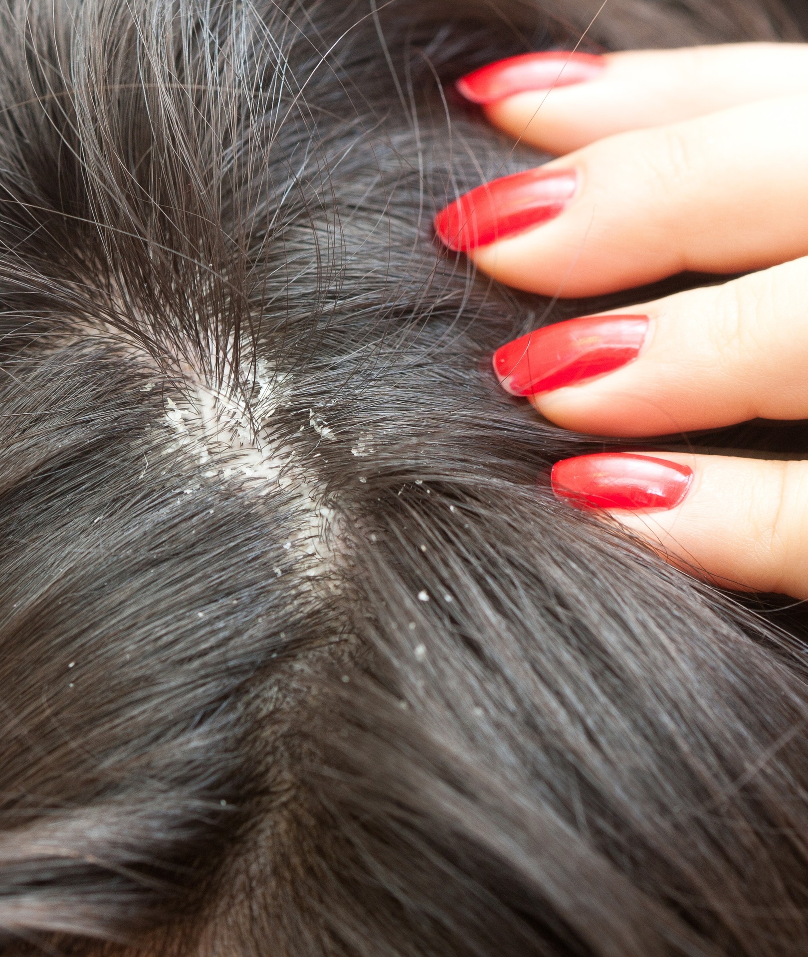 Para acabar com a caspa, você deve evitar práticas que mantenham seu couro cabeludo quente, úmido e escuro