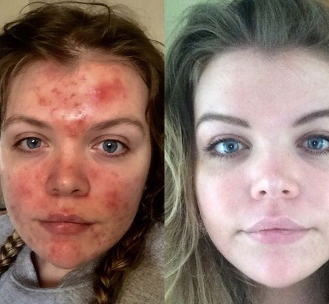 foto do rosto de uma menina antes e depois do tratamento com Roacutan