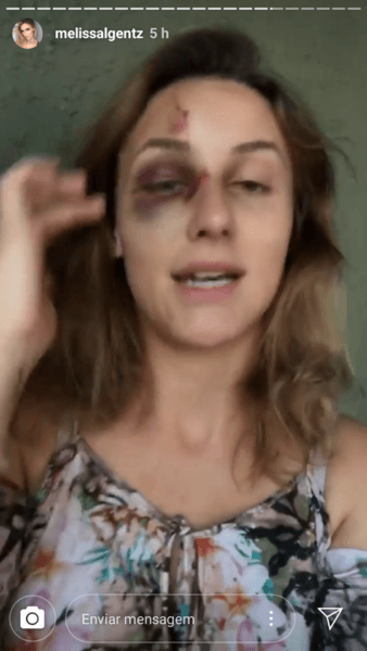 Brasileira agredida pelo namorado nos EUA fica com o rosto bastante machucado