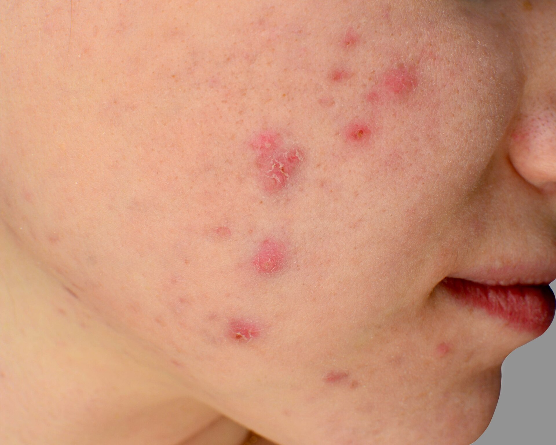 Se feita da maneira incorreta, a limpeza de pele pode agravar seu quadro de acne