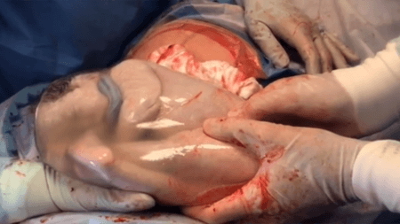 O obstetra compartilhou um vídeo que mostra um dos gêmeos “empelicados” dentro da bolsa amniótica