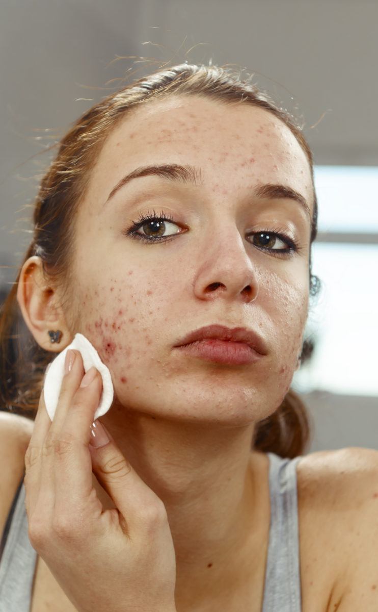 40% das mulheres com mais de 25 anos têm acne