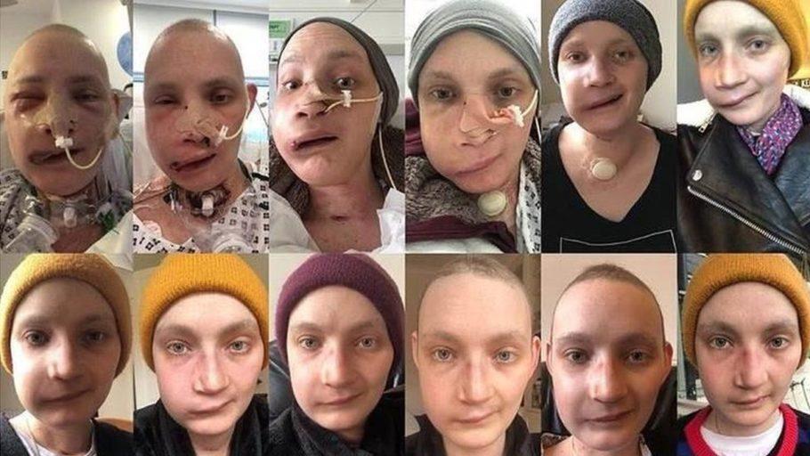 Jen tirou fotos do seu rosto todos os dias para mostrar evolução da reconstrução facial