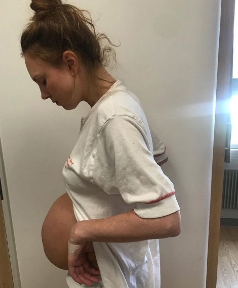 Foto da barriga 4 dias após a cesárea